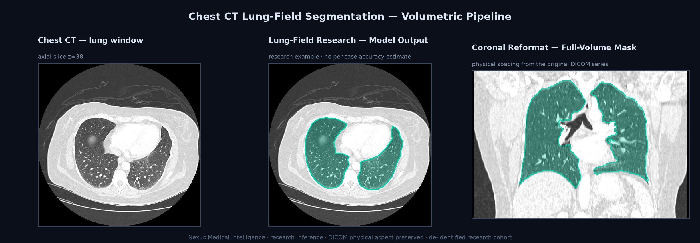 Chest CT lung-field segmentation