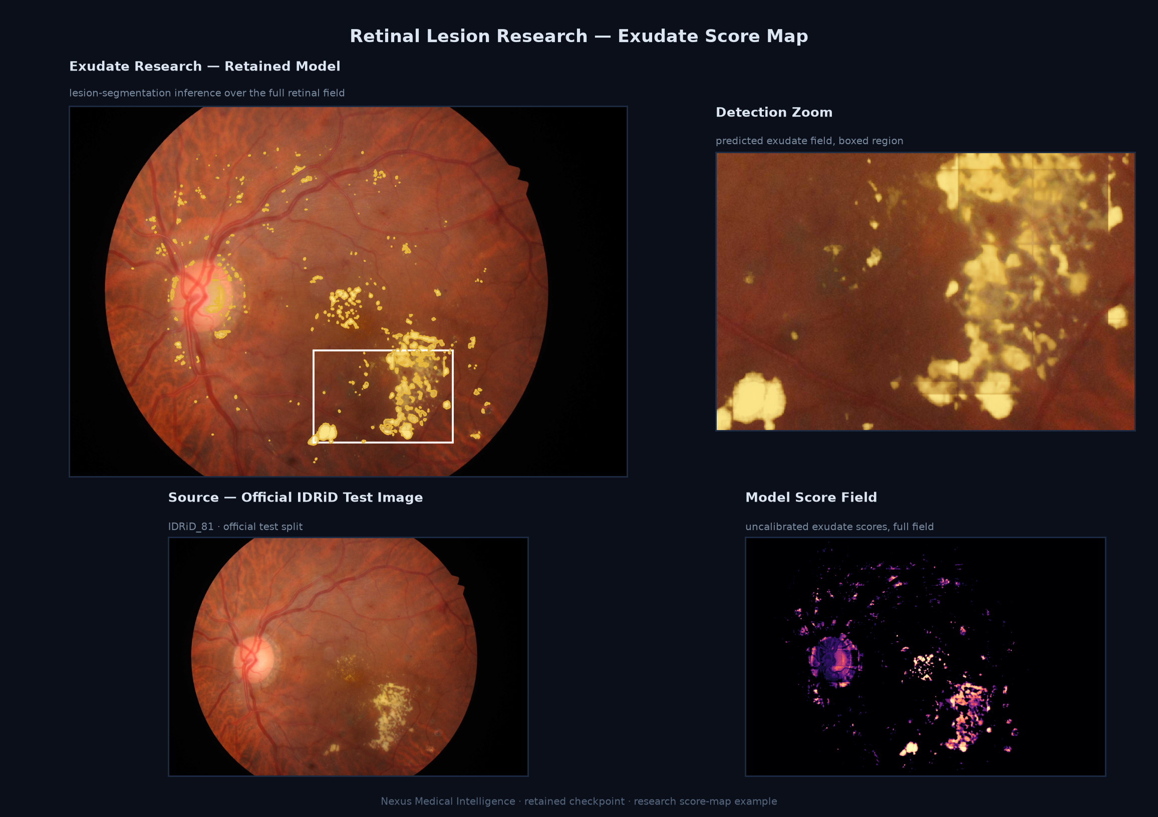 Retinal exudate research view
